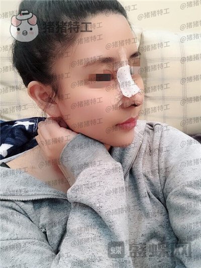 重庆木槿张平隆鼻案例价格分享,做完我都觉得自己太可爱了~