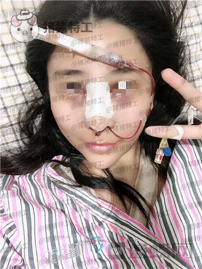 重庆木槿张平隆鼻案例价格分享,做完我都觉得自己太可爱了~