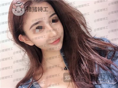 重庆木槿张平隆鼻案例价格分享,做完我都觉得自己太可爱了~