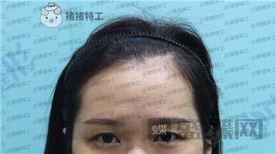 武汉中爱铭医祁向峰眼部手术案例价格分享,显老的眼睛做完一下变得精致起来~