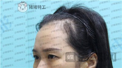 武汉中爱铭医祁向峰眼部手术案例价格分享,显老的眼睛做完一下变得精致起来~