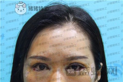 武汉中爱铭医祁向峰眼部手术案例价格分享,显老的眼睛做完一下变得精致起来~