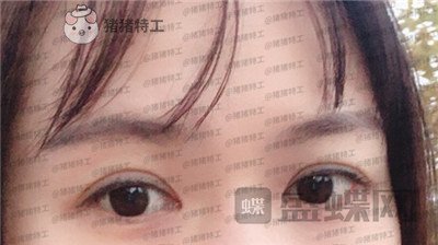 武汉中爱铭医祁向峰眼部手术案例价格分享,显老的眼睛做完一下变得精致起来~
