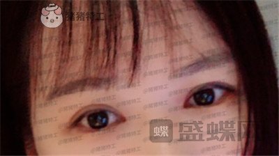 武汉中爱铭医祁向峰眼部手术案例价格分享,显老的眼睛做完一下变得精致起来~