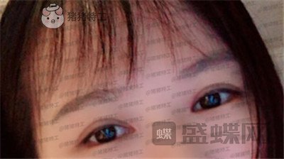 武汉中爱铭医祁向峰眼部手术案例价格分享,显老的眼睛做完一下变得精致起来~