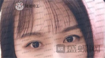 武汉中爱铭医祁向峰眼部手术案例价格分享,显老的眼睛做完一下变得精致起来~