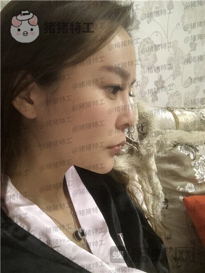 重庆铂生杜亚旭隆鼻案例价格分享,路人变女神一个鼻子就够了?