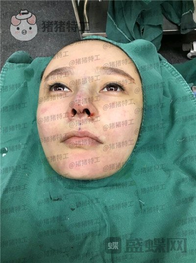 重庆铂生杜亚旭隆鼻案例价格分享,路人变女神一个鼻子就够了?