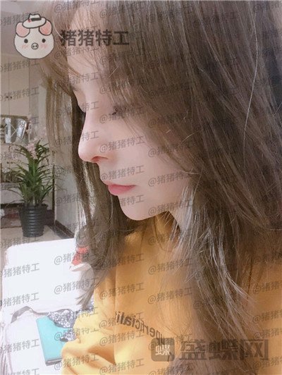 重庆铂生杜亚旭隆鼻案例价格分享,路人变女神一个鼻子就够了?