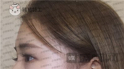 南京美贝尔张永升缩鼻翼案例价格分享,鼻子眼睛好看了相当于换了个头?