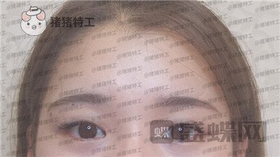 南京美贝尔张永升缩鼻翼案例价格分享,鼻子眼睛好看了相当于换了个头?