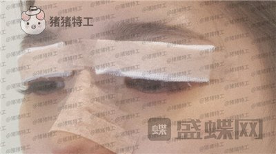 南京美贝尔张永升缩鼻翼案例价格分享,鼻子眼睛好看了相当于换了个头?