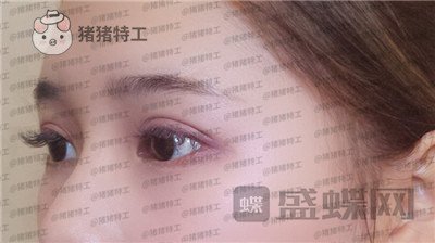 南京美贝尔张永升缩鼻翼案例价格分享,鼻子眼睛好看了相当于换了个头?