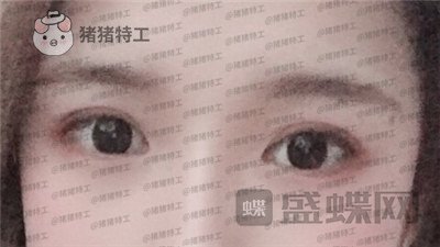 南京美贝尔张永升缩鼻翼案例价格分享,鼻子眼睛好看了相当于换了个头?