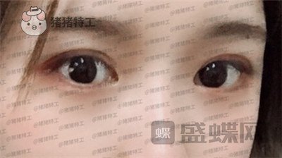 南京美贝尔张永升缩鼻翼案例价格分享,鼻子眼睛好看了相当于换了个头?