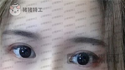 南京美贝尔张永升缩鼻翼案例价格分享,鼻子眼睛好看了相当于换了个头?
