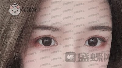 南京美贝尔张永升缩鼻翼案例价格分享,鼻子眼睛好看了相当于换了个头?