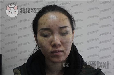 成都西区医院车红昌鼻部手术案例价格分享,拍照不用p的感觉真好~