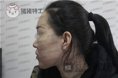 成都西区医院车红昌鼻部手术案例价格分享,拍照不用p的感觉真好~