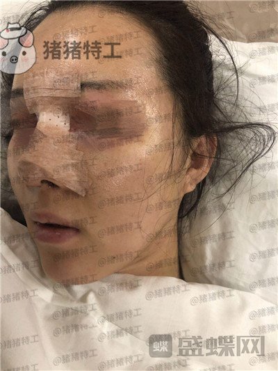 成都西区医院车红昌鼻部手术案例价格分享,拍照不用p的感觉真好~