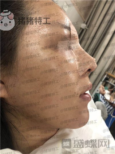 成都西区医院车红昌鼻部手术案例价格分享,拍照不用p的感觉真好~