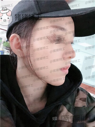 成都西区医院车红昌鼻部手术案例价格分享,拍照不用p的感觉真好~