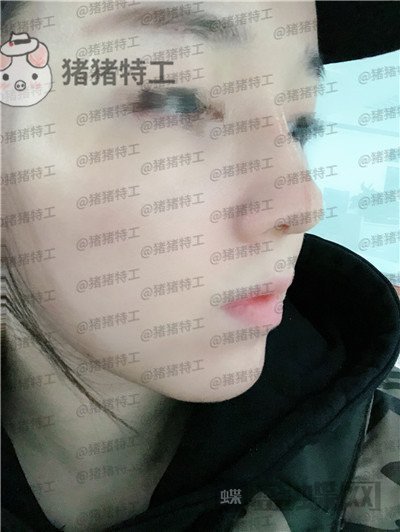 成都西区医院车红昌鼻部手术案例价格分享,拍照不用p的感觉真好~