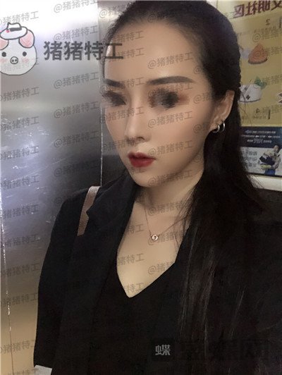 成都西区医院车红昌鼻部手术案例价格分享,拍照不用p的感觉真好~