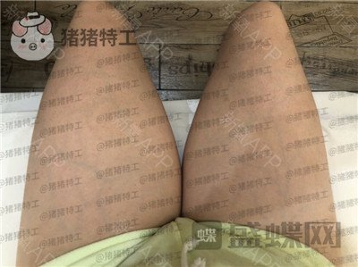北京八大处杨增杰吸脂案例价格分享,大腿胖怎么办筷子腿了解一下~