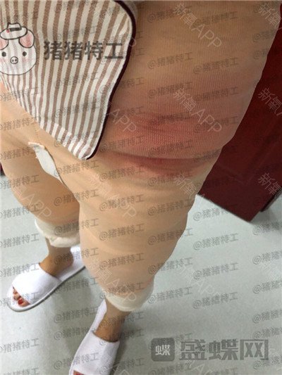 北京八大处杨增杰吸脂案例价格分享,大腿胖怎么办筷子腿了解一下~