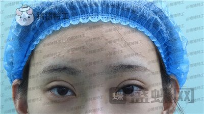 上海九院王维双眼皮修复案例价格分享,之前超假的眼睛现在总算得到了解决~