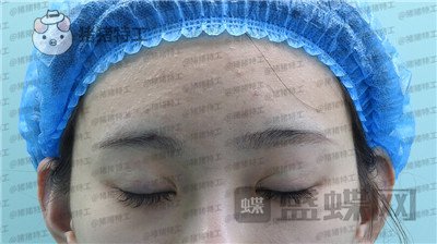 上海九院王维双眼皮修复案例价格分享,之前超假的眼睛现在总算得到了解决~