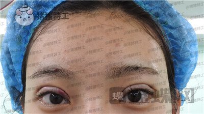 上海九院王维双眼皮修复案例价格分享,之前超假的眼睛现在总算得到了解决~