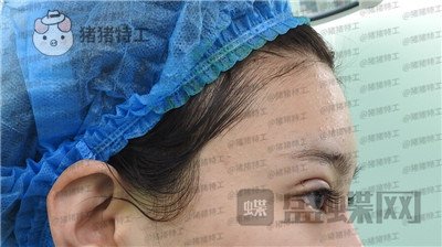 上海九院王维双眼皮修复案例价格分享,之前超假的眼睛现在总算得到了解决~
