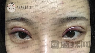 上海九院王维双眼皮修复案例价格分享,之前超假的眼睛现在总算得到了解决~