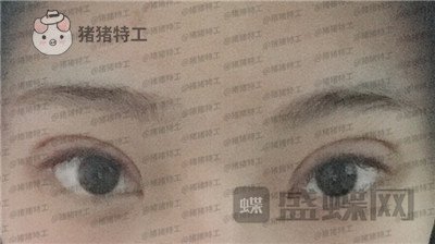 上海九院王维双眼皮修复案例价格分享,之前超假的眼睛现在总算得到了解决~