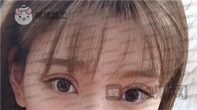 上海九院王维双眼皮修复案例价格分享,之前超假的眼睛现在总算得到了解决~