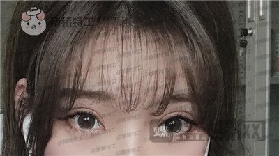 上海九院王维双眼皮修复案例价格分享,之前超假的眼睛现在总算得到了解决~
