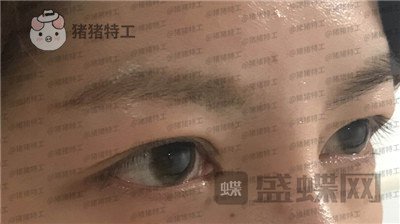 上海九院苏婷双眼皮修复案例价格分享,之前眼睛不对称很难看终于有救了!
