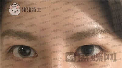 上海九院苏婷双眼皮修复案例价格分享,之前眼睛不对称很难看终于有救了!
