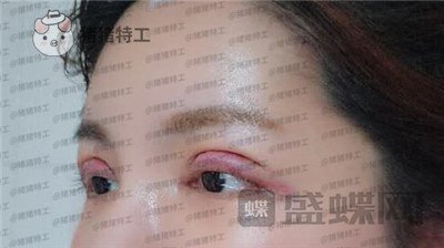 上海九院苏婷双眼皮修复案例价格分享,之前眼睛不对称很难看终于有救了!
