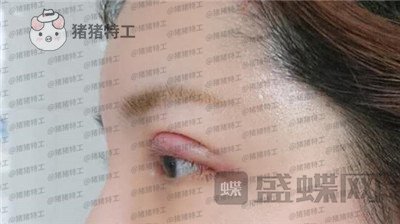 上海九院苏婷双眼皮修复案例价格分享,之前眼睛不对称很难看终于有救了!