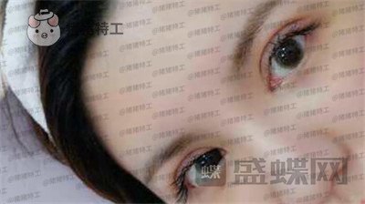 上海九院苏婷双眼皮修复案例价格分享,之前眼睛不对称很难看终于有救了!