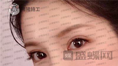 上海九院苏婷双眼皮修复案例价格分享,之前眼睛不对称很难看终于有救了!