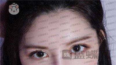 上海九院苏婷双眼皮修复案例价格分享,之前眼睛不对称很难看终于有救了!