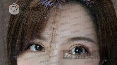 上海九院苏婷双眼皮修复案例价格分享,之前眼睛不对称很难看终于有救了!