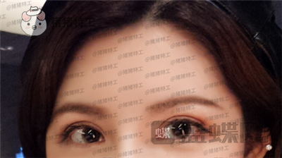上海九院苏婷双眼皮修复案例价格分享,之前眼睛不对称很难看终于有救了!