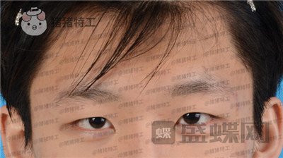北京美莱余辉眼部手术案例价格分享,这个男生做完眼睛好像吴磊有没有?