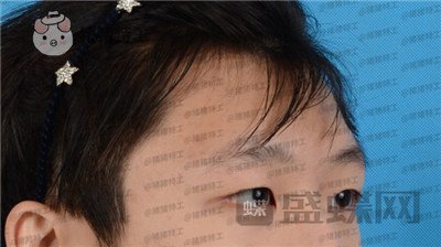 北京美莱余辉眼部手术案例价格分享,这个男生做完眼睛好像吴磊有没有?