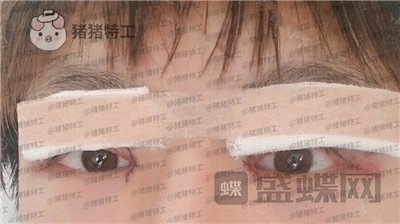 北京美莱余辉眼部手术案例价格分享,这个男生做完眼睛好像吴磊有没有?